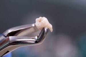 wisdom teeth extraction sydney-wisdom teeth professionals-sydney 