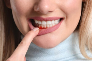 Save Your Gums and Teeth - wisdom teeth professionals - sydney