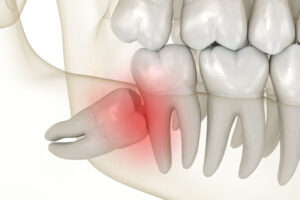 wisdom teeth removal - wisdom teeth professionals - sydney