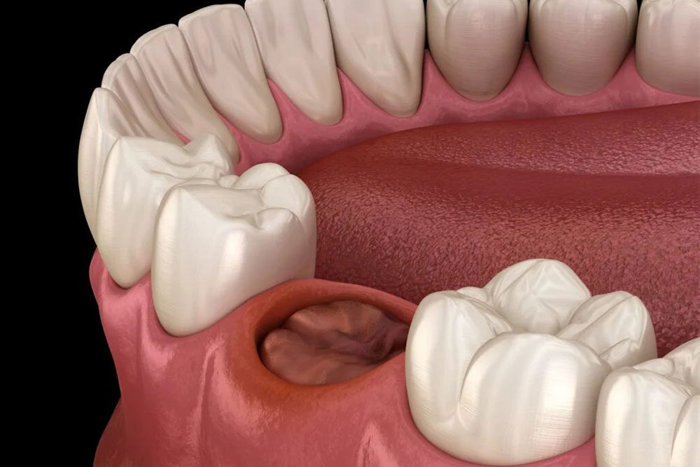Healing process of wisdom tooth socket after extraction
