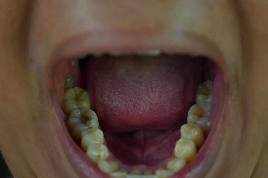 Close up of mans teeth with wisdom tooth infection causing swollen gums